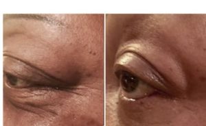 modere-biocell-skin-before-and-after