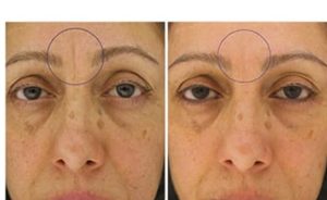 modere-biocell-skin-before-and-after